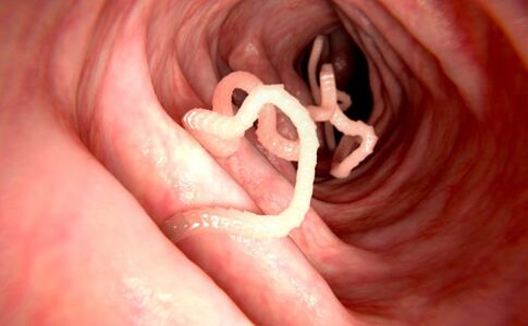 Würmer im menschlichen Körper