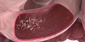 Die Verwendung von Tripletts zum Entfernen von Parasiten