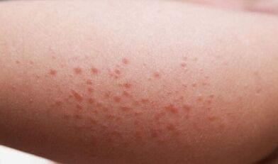 Äußere Manifestationen des Vorhandenseins von Parasiten im Körper