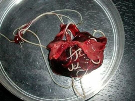 Würmer aus dem menschlichen Körper